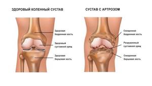 Боли сильные в ногах.особено в коленях - советы врачей на каждый день