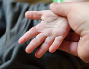 Прыщи на руках у 1,5 ребёнка - советы врачей на каждый день